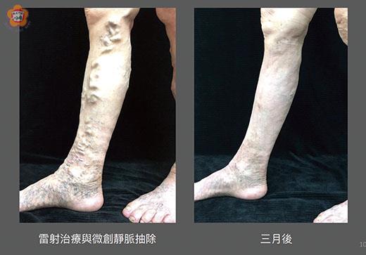 金門醫院運用雷射與微創手術治療靜脈曲張,將手術後不適與疼痛降至最低,且限縮傷口在0.1公分左右,左為術前,右為術後。(金門醫院提供)